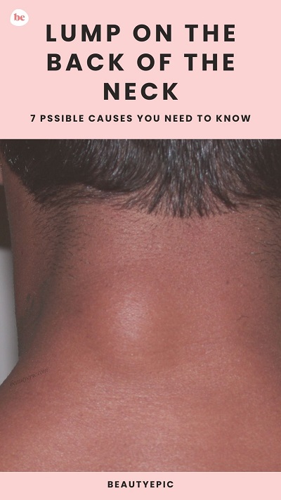 Lump on the Back of the Neck