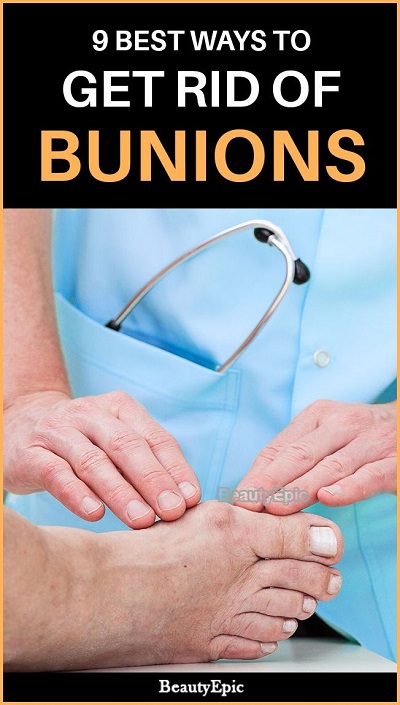 How To Get Rid Of Bunions Without Surgery