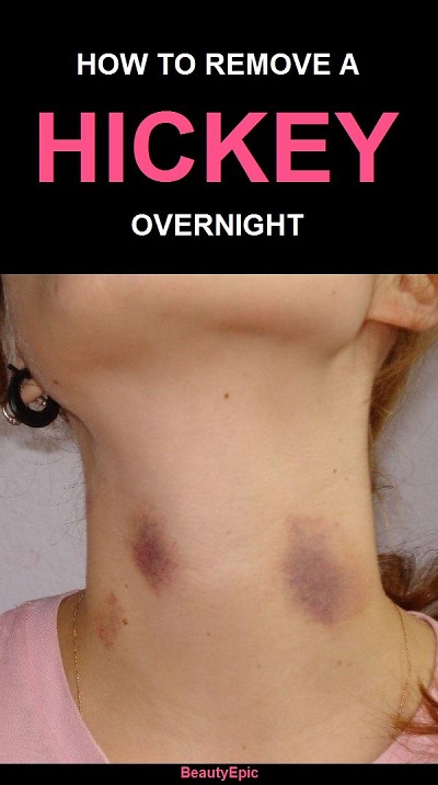 Top 10 Easy Ways To Get Rid Of A Hickey Overnight In 2025