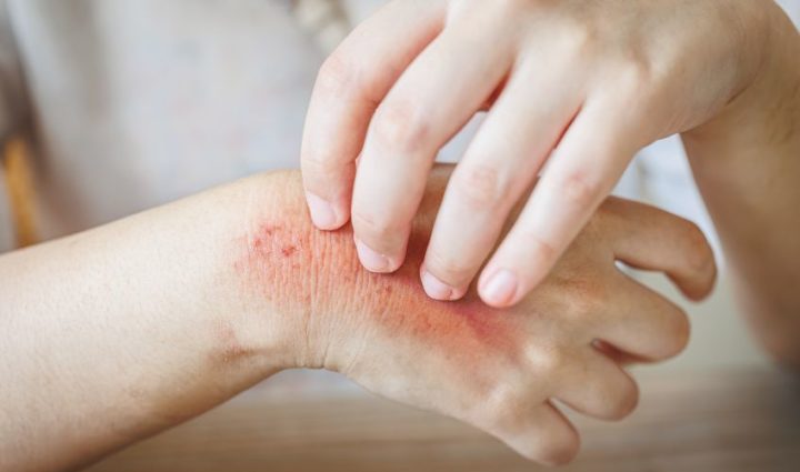 Treat Skin Infections