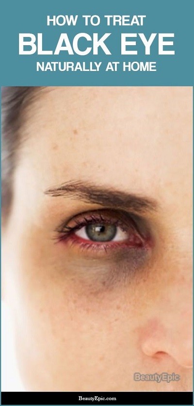 Get Rid Of That Black Eye With These 13 Effective Remedies