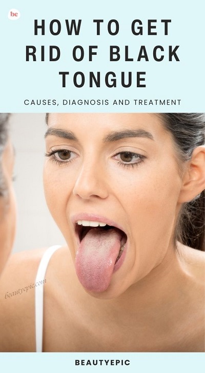 How to Get rid of Black Tongue