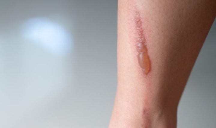 Burnt Skin