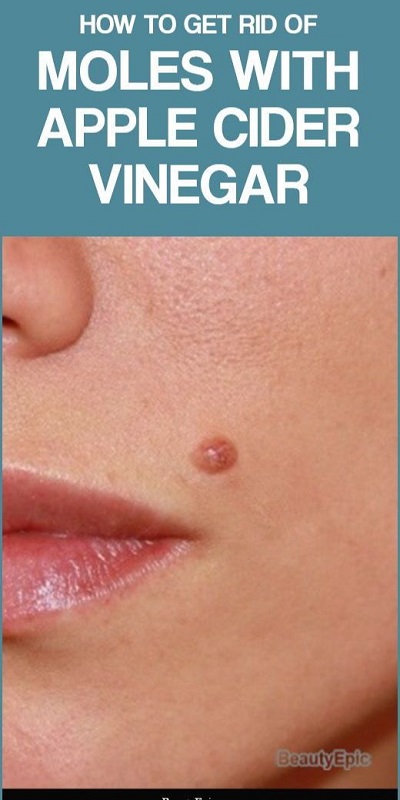 How To Remove A Mole With Apple Cider Vinegar