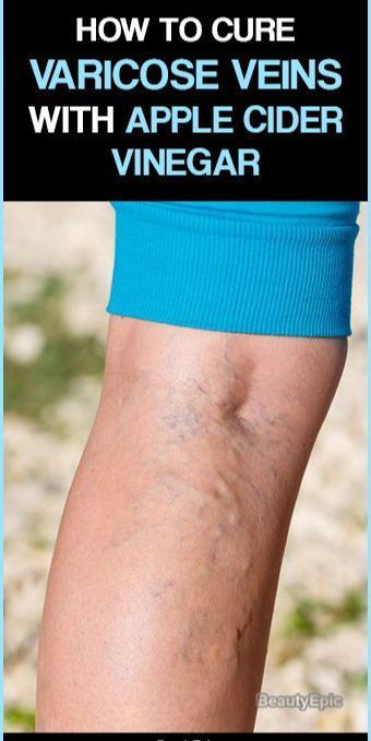 How Does Apple Cider Vinegar Help Varicose Veins