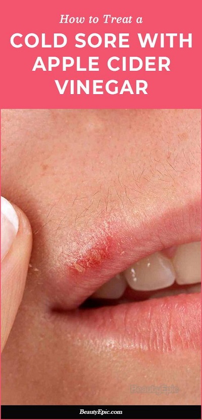 How Does Apple Cider Vinegar Help Cold Sores