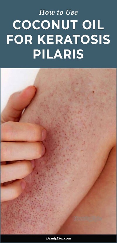 How To Use Coconut Oil For Keratosis Pilaris