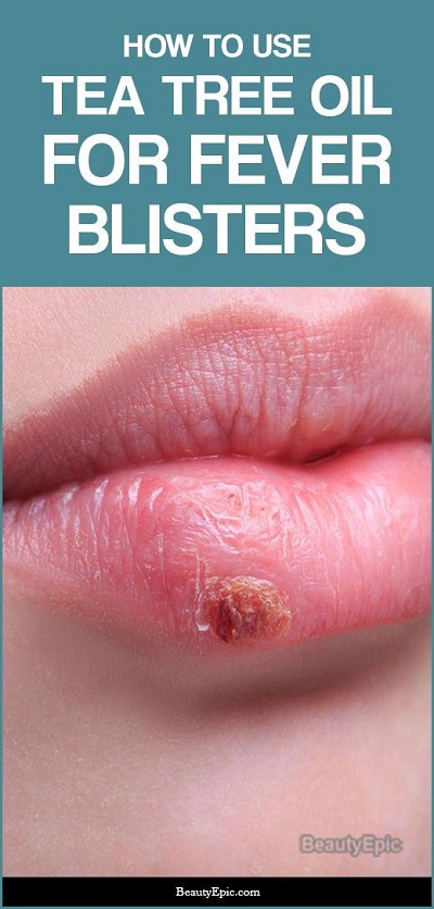 How To Get Rid Of Fever Blisters Using Tea Tree Oil