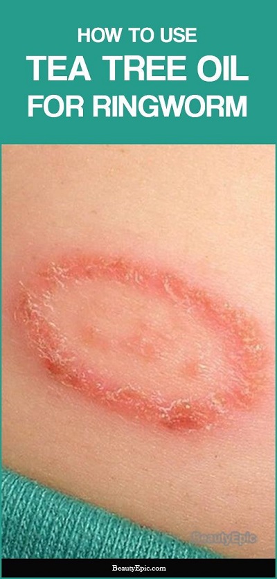 How To Apply Tea Tree Oil For Ringworm