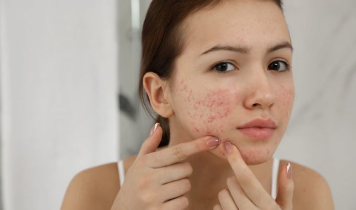 Treat Acne