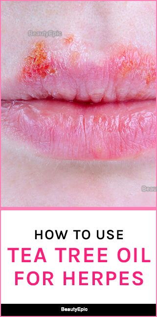 How To Use Tea Tree Oil For Herpes