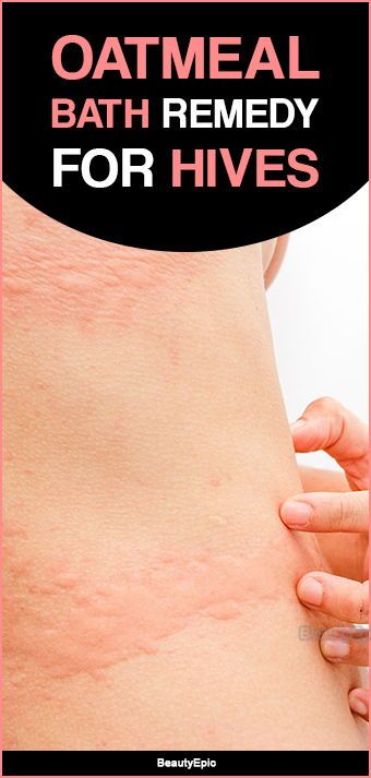 Oatmeal Bath Remedy For Hives: How To Use