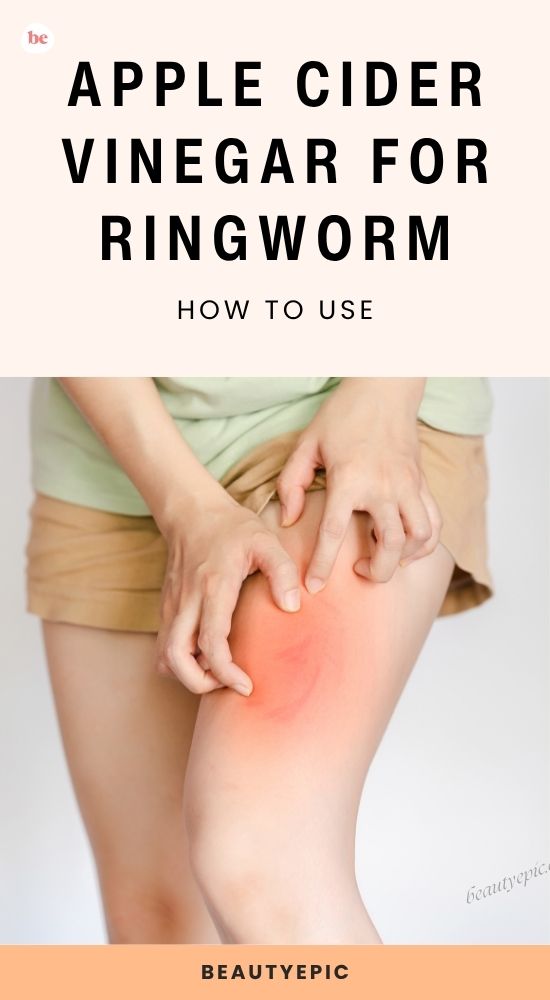 Apple Cider Vinegar for Ringworm