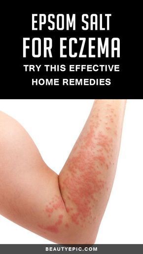 How To Use Epsom Salt For Eczema