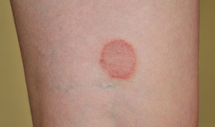 Does Apple Cider Vinegar Cure Ringworm