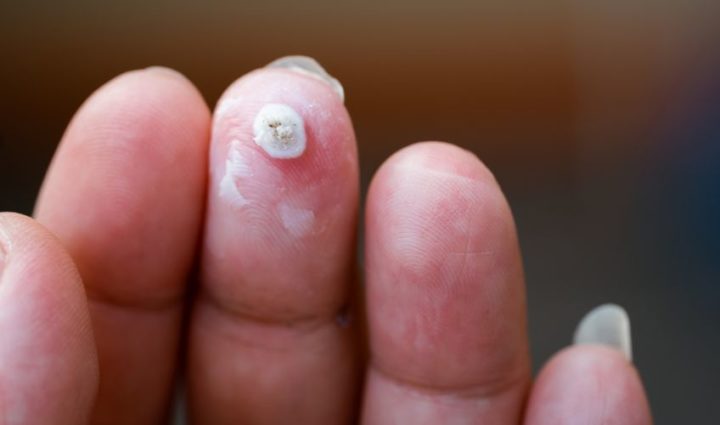 Tea Tree oil for Genital Warts