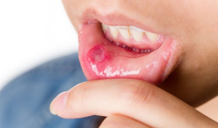 Beeswax and Coconut oil for Canker Sores