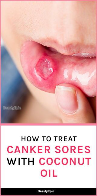 Coconut Oil For Canker Sores