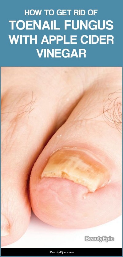 How To Prepare An Apple Cider Vinegar For Toenail Fungus