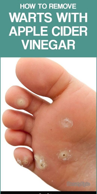 How to Use Apple Cider Vinegar for Warts Removal