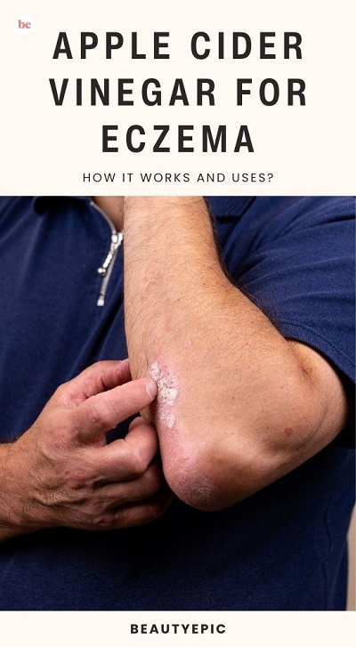 Apple cider vinegar for eczema