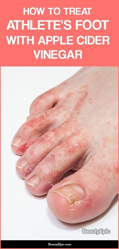 How to Use Apple Cider Vinegar for Athlete's Foot