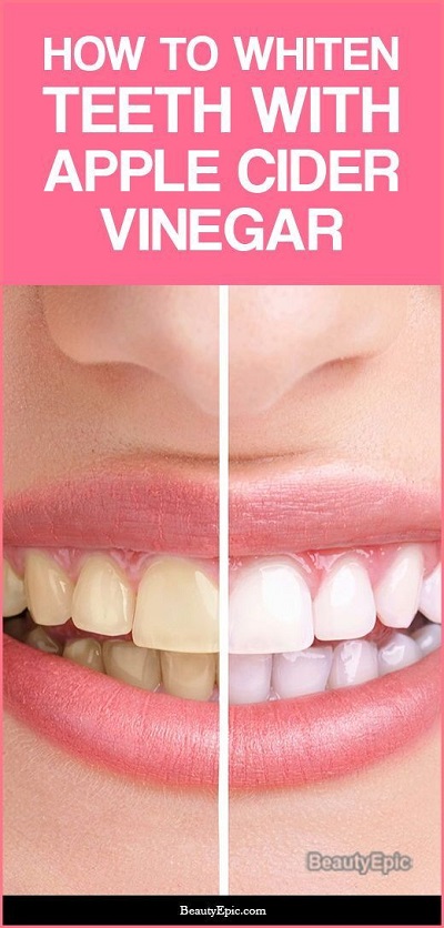 Apple Cider Vinegar For Teeth Whitening