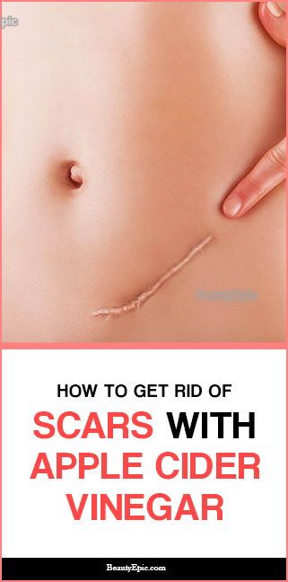 How To Use Apple Cider Vinegar For Scars