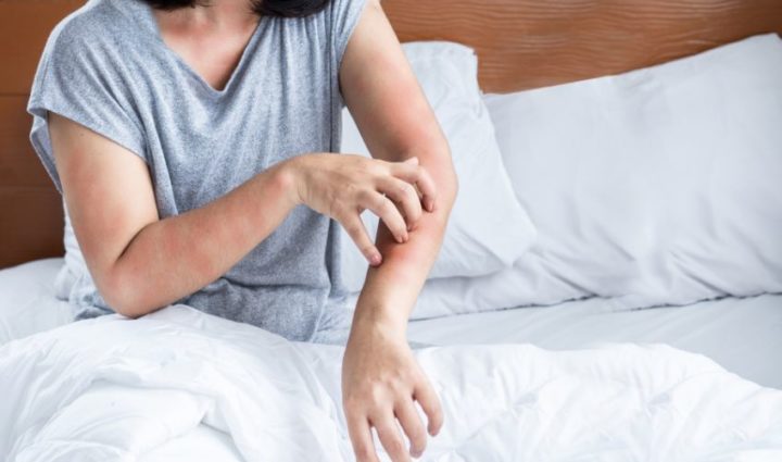 Itching and Rashes