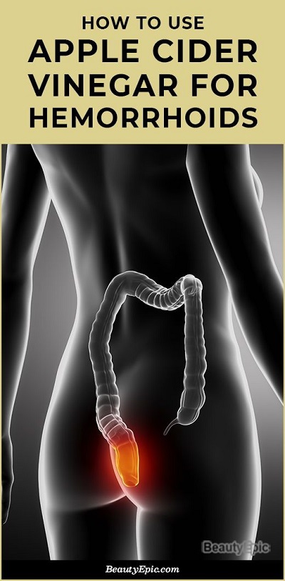 Apple Cider Vinegar for Hemorrhoids