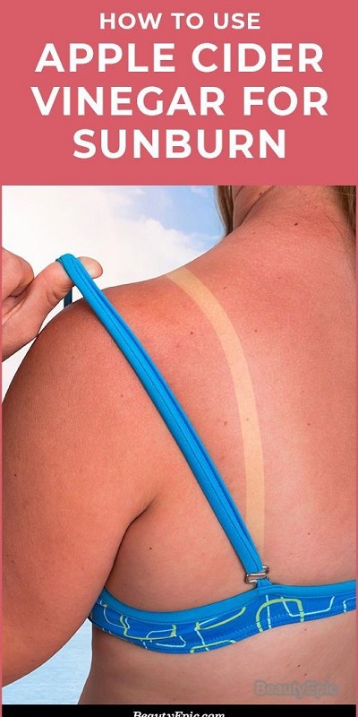 Apple Cider Vinegar for Sunburn