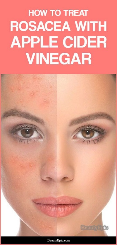How To Use Apple Cider Vinegar To Treat Rosacea