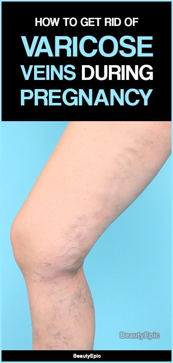 How To Get Rid Of Varicose Veins During Pregnancy