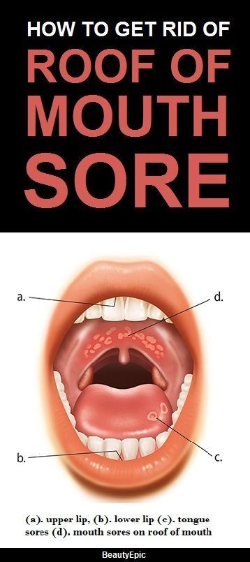 5 Easy Ways To Get Rid Of Roof Of Mouth Sore At Home In 2025