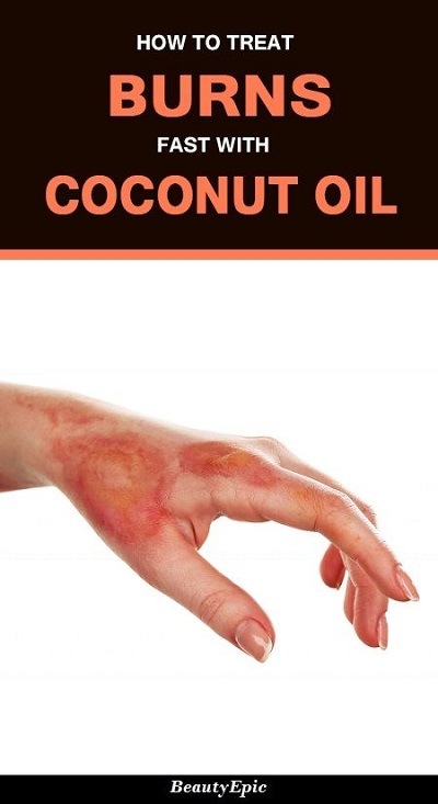 How To Use Coconut Oil For Heal Burns