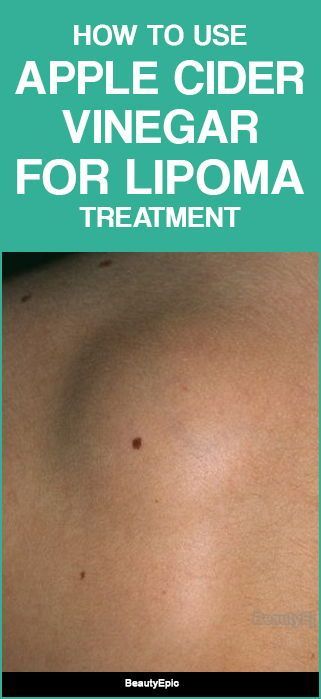 How To Use Apple Cider Vinegar For Lipoma Treatment