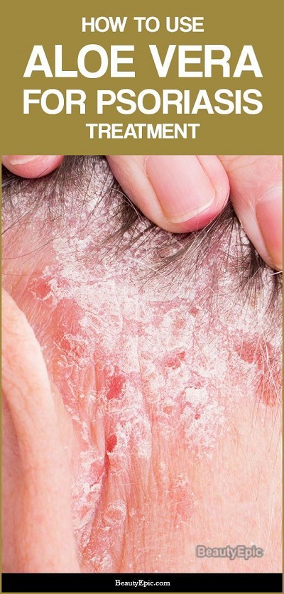 Aloe Vera for Psoriasis