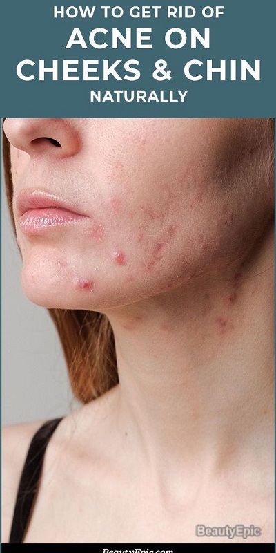 How to Get Rid of Acne on Cheeks and Chin Naturally