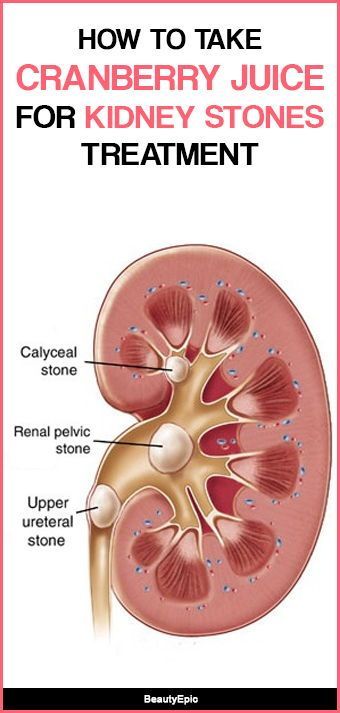 How Good Is Cranberry Juice For Kidney Stones