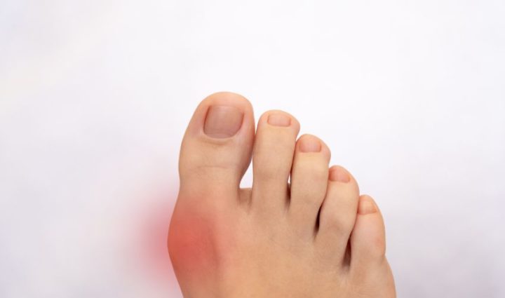Tart Cherry Juice For Gout