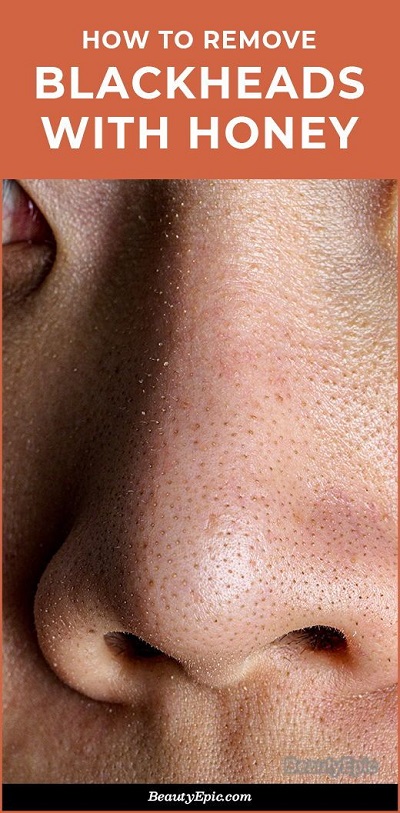 How to Use Honey for Blackhead Removal