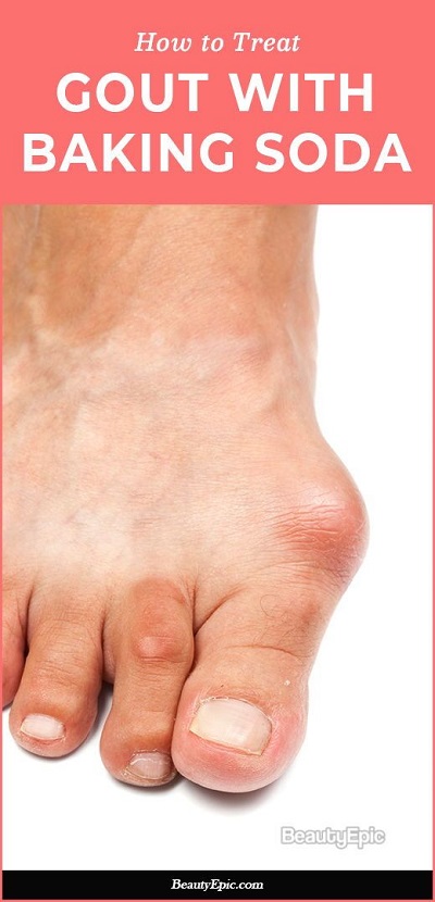 Can baking soda treat a gout