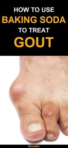 Baking Soda For Gout