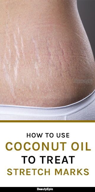 How To Use Coconut Oil To Remove Your Stretch Marks