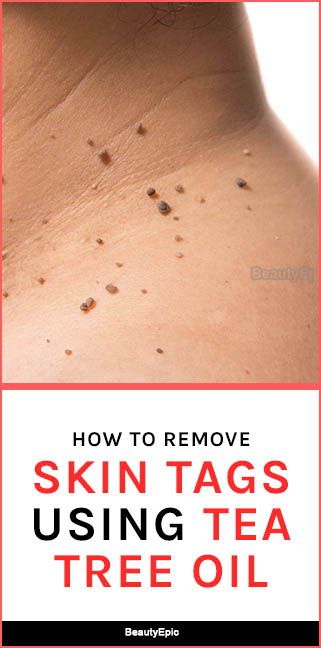 How To Remove Skin Tags With Tea Tree Oil