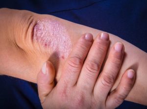 Coconut Oil for Psoriasis Is It Effective