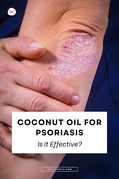 Coconut Oil for Psoriasis