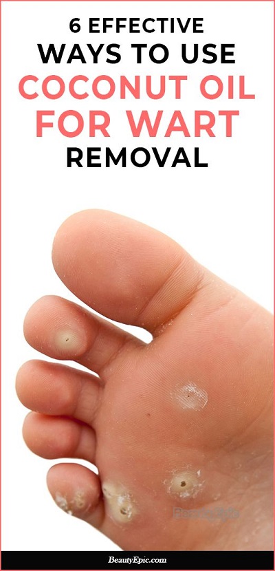 Coconut oil for Warts