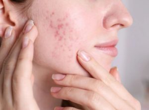 How to Remove Acne Scars Quickly with Apple Cider Vinegar