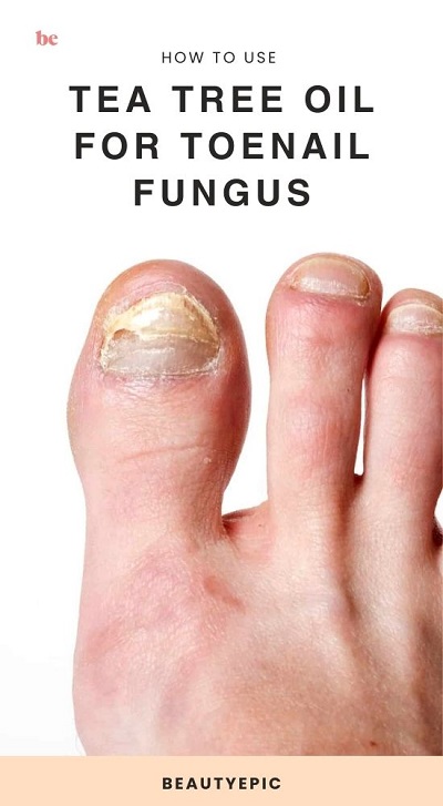 Tea Tree oil for toenail fungus
